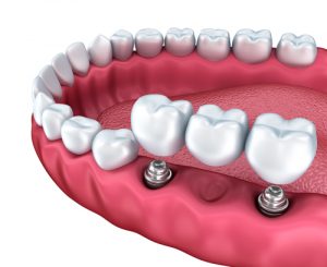 Implant Bridges